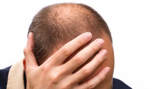 Hói đầu có thể liên quan đến ung thư tuyến tiền liệt và tăng nguy cơ tử vong do bệnh này. Ảnh: Fox News