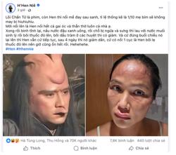 H'Hen Niê tiết lộ bị nổi mề đay sau sinh, bác sĩ nói gì về tình trạng này?