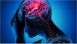 Đột quỵ gia tăng: Nghiên cứu Mỹ hé lộ thủ phạm mới