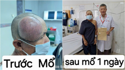 Bệnh viện Đa khoa vùng Tây Nguyên: Phẫu thuật thành công cho bệnh nhân có u “khổng lồ” ở đầu