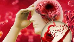 Nhiều người trẻ bị đột quỵ, có cần tầm soát nguy cơ?