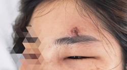 Nặn mụn trứng cá, nữ bệnh nhân nhập viện nguy kịch