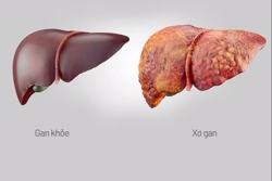 Dinh dưỡng hợp lý - yếu tố sống còn với người bệnh xơ gan