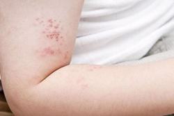 Liệt mặt do zona: Hiểm họa có thể phòng ngừa