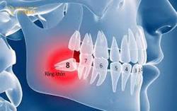 Khi nào cần nhổ răng khôn?