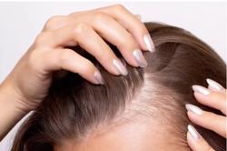 Chế độ ăn uống của 61.000 người hé lộ nguyên nhân gây rụng tóc