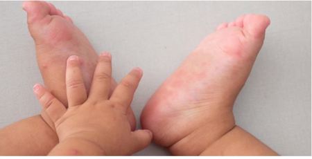 Bộ Y tế khuyến cáo không chủ quan với sốt xuất huyết và tay chân miệng