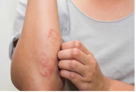 Đề phòng những bệnh về da trong mùa lạnh