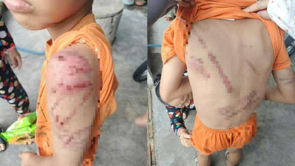 Lý do người cha đánh con 10 tuổi bầm tím khắp người