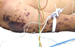 4 ca tử vong do não mô cầu, Bộ Y tế cảnh báo nguy cơ