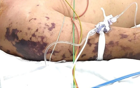 4 ca tử vong do não mô cầu, Bộ Y tế cảnh báo nguy cơ