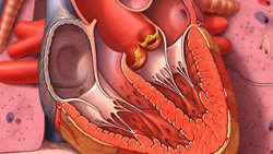 Đề phòng viêm nội tâm mạc do nhiễm khuẩn răng miệng