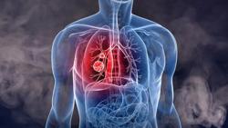 Hơn 20.000 người chết vì ung thư phổi trong năm 2020