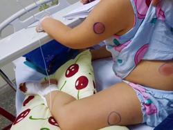 Phát hiện 1 bé gái ở Quảng Bình nhiễm vi khuẩn "ăn thịt người"