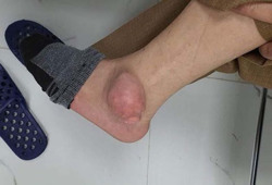 Cảnh báo chữa gout bằng thuốc mua qua mạng