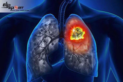 Mỗi năm Việt Nam có 170.000 ca mắc lao mới