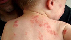 Bệnh ngoài da tăng do nắng nóng