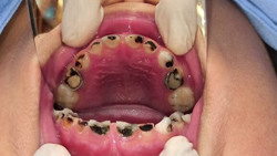 Nguyên nhân gây sâu răng ở trẻ và cách phòng tránh