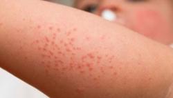 Nắng nóng, đề phòng bệnh ngoài da