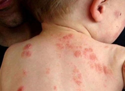 Phòng tránh các bệnh về da trong mùa hè nắng nóng