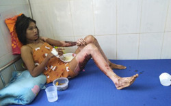 Đáng thương người phụ nữ bị bỏng xăng