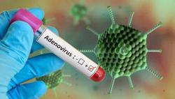 Không nên lạm dụng việc xét nghiệm Adenovirus tại nhà