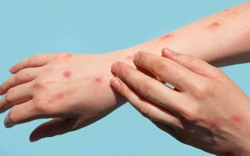 Bộ y tế đề nghị các địa phương tăng cường phòng chống bệnh đậu mùa khỉ