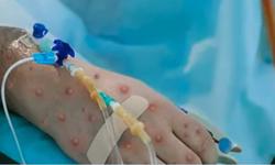 Chủ động ứng phó, giám sát bệnh đậu mùa khỉ