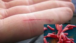 Gi nhận 3 ca bệnh Whitmore, Bộ Y tế khuyến cáo chủ động phòng tránh