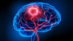 Tự ý bổ sung loại vitamin này, coi chừng ung thư di căn não