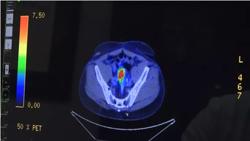 Phòng bệnh ung thư tuyến tiền liệt, cách tốt nhất là gì?