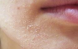 Da khô, nứt nẻ mùa lạnh, bác sĩ bày cách xử lý