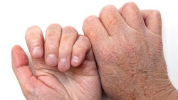 Cảnh báo tình trạng da nứt nẻ, ngứa ngáy trong mùa lạnh