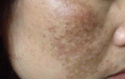 Phát hiện mẫu kem trị nám có hàm lượng thủy ngân vượt mức