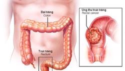 Mỗi năm, có khoảng 16.000 ca ung thư đại trực tràng mới