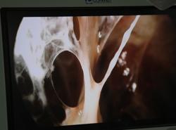 Hai bệnh nhân có phổi đông đặc, xơ hóa nghi do di chứng COVID-19