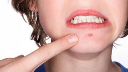 Đừng chủ quan khi mụn nhọt xuất hiện