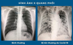 Hậu COVID-19 và những điều có thể bạn chưa biết