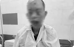 Dùng điện thoại khi đang sạc, nam thanh niên cháy sém toàn thân, nguy cơ mù