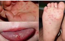 Hơn 5.500 ca tay chân miệng, Bộ Y tế cảnh báo dịch gia tăng