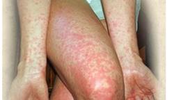 Số mắc sốt xuất huyết tăng 97%, Bộ Y tế cảnh báo dịch rất phức tạp