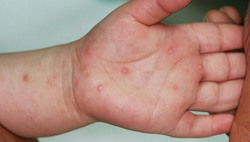 Bệnh tay chân miệng có tái nhiễm?