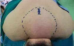 Tăng cân khó kiểm soát, hoá ra mắc bệnh đau mỡ hiếm gặp