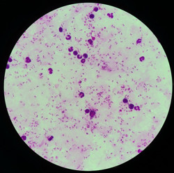 TP HCM: Phát hiện 2 người bị sốt rét ác tính về từ châu Phi