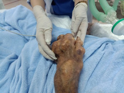 Bệnh gout: Gia tăng bệnh nhân trẻ tuổi