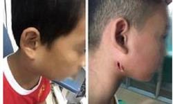 Đắk Lắk: Phát hiện 1 bệnh nhi mắc bệnh "vi khuẩn ăn thịt người"