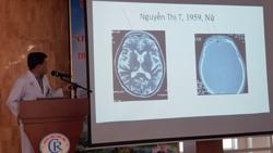 Hàng loạt ca Covid-19 áp xe, hoại tử sọ mặt