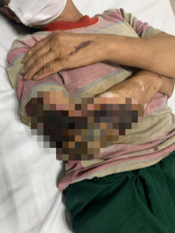 12 bệnh nhân nhiễm trùng, hoại tử trong 1 tháng sau dùng thuốc nam đắp vết thương