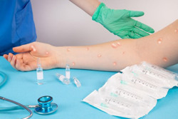 Bệnh đậu mùa khỉ diễn biến phức tạp: Tăng cường giám sát, chẩn đoán, điều trị