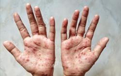 Bộ Y tế: Người mắc bệnh đậu mùa khỉ cách ly tối thiểu 14 ngày
